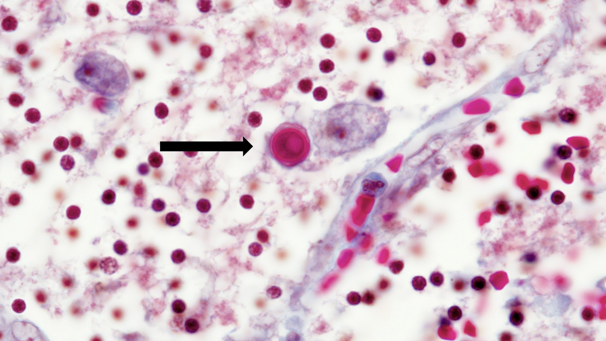 High resolution of Acanthamoeba in a patient's brain