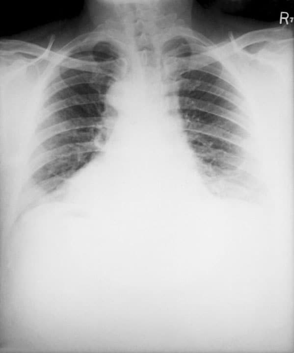 This posteroanterior (PA) chest x-ray was taken 4 months after the symptoms of anthrax started in a 46-year-old man.