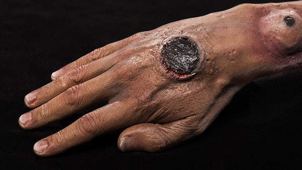 photo of a large anthrax lesion on a person's hand