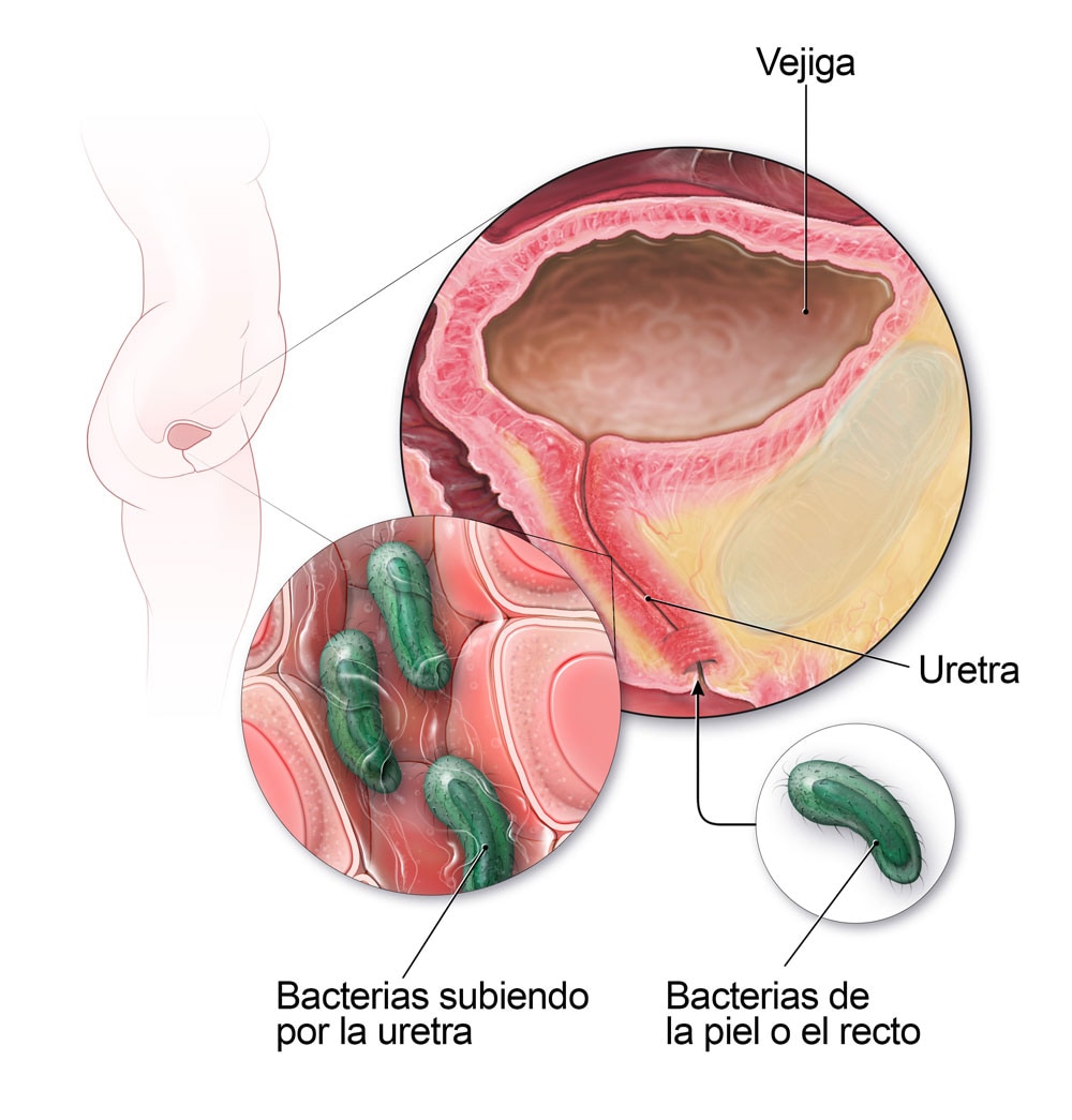 Diagrama de la anatomía del aparato urinario que muestra cómo las bacterias pueden causar una infección.