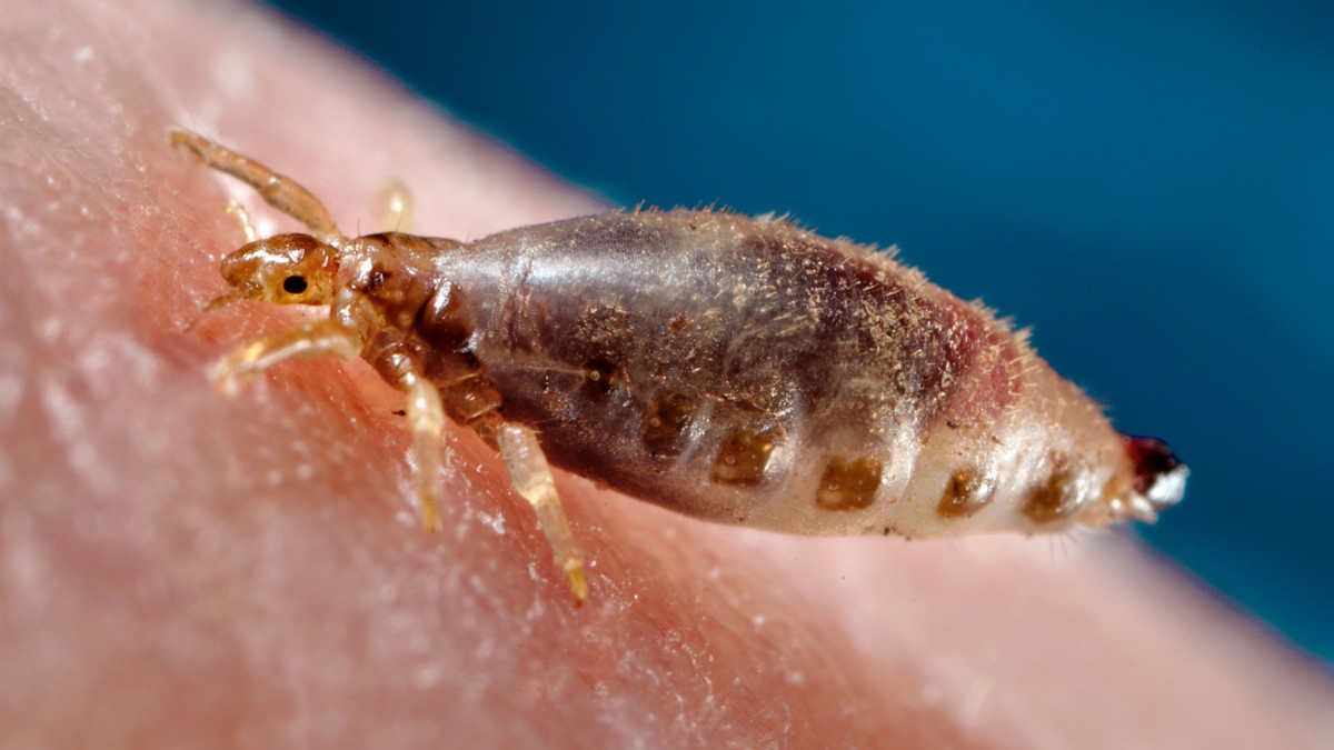 Human body louse spread Bartonella quintana