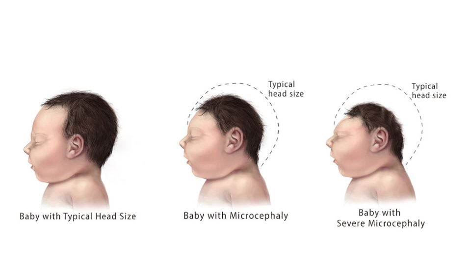 Ilustración de tres bebés, uno cuya cabeza es del tamaño típico, uno con una cabeza microcefálica pequeña y uno con una cabeza extremadamente pequeña con microcefalia grave.