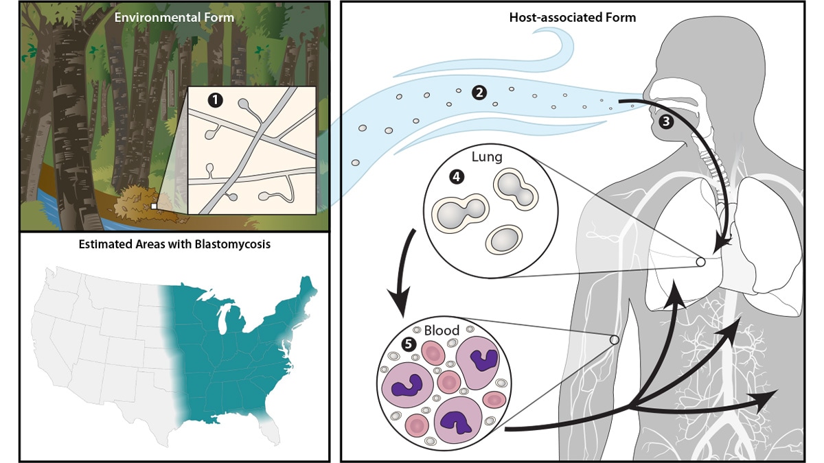 Image of the life cycle of Blastomyces: Environmental Form, Host-associated Form, and Areas of Endemicity for Blastomycosis