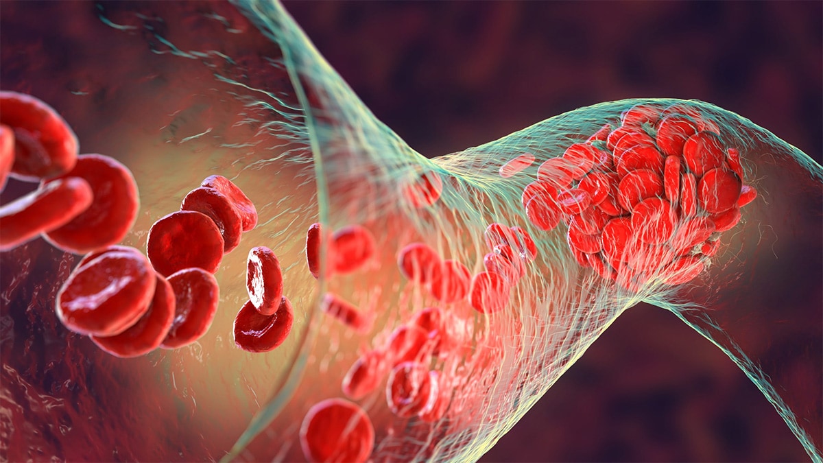 Blood clot blocking red blood cells from traveling through a vein