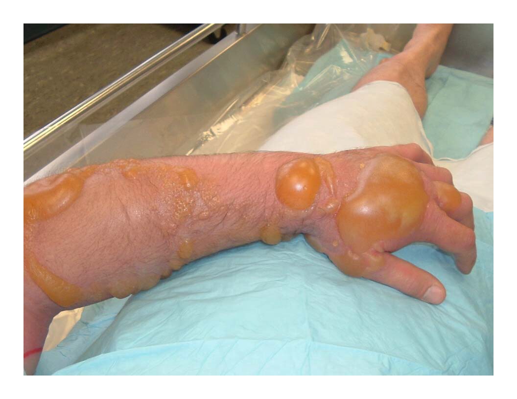 An image of a hand and forearm with burns and blisters from mustard exposure.