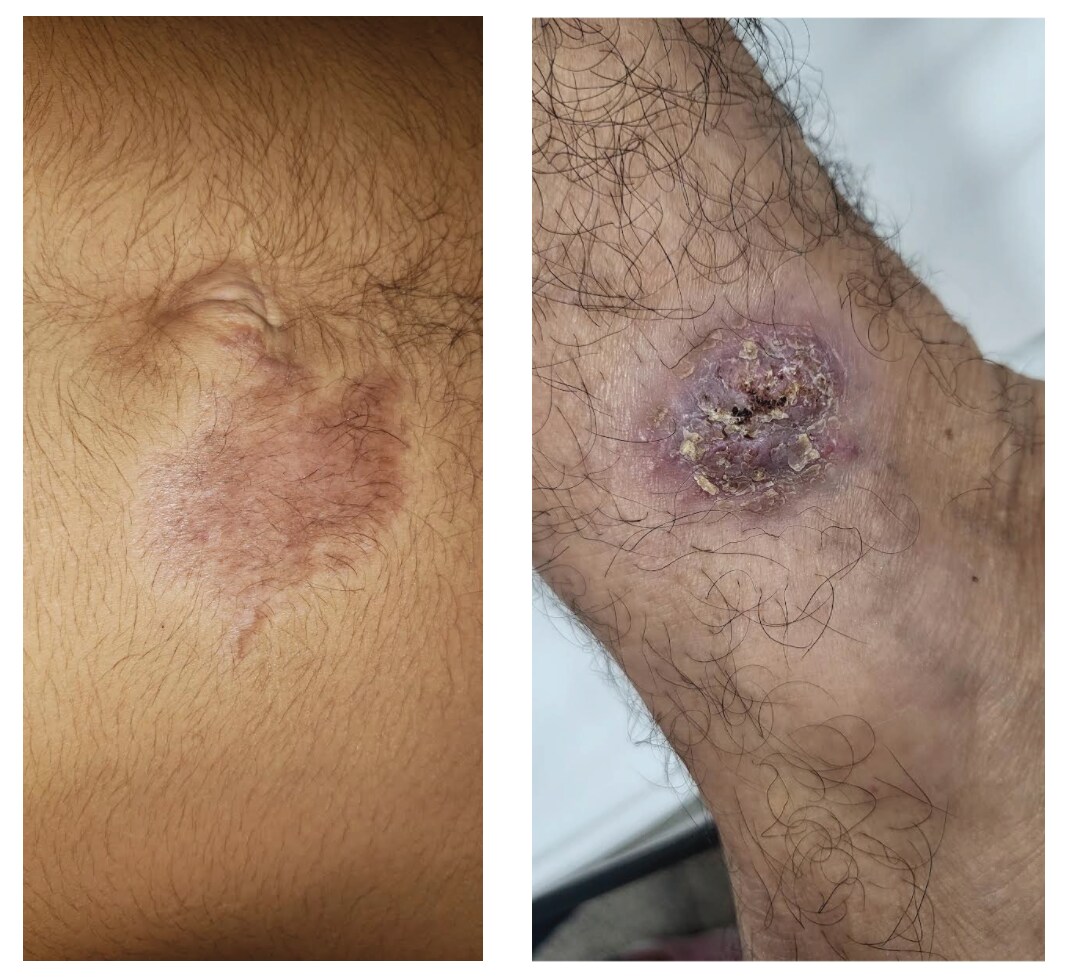 Early and late stage of chromoblastomycosis infection.