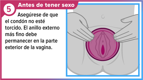 Un par de manos posicionando el condón femenino de manera que cubra la vulva.