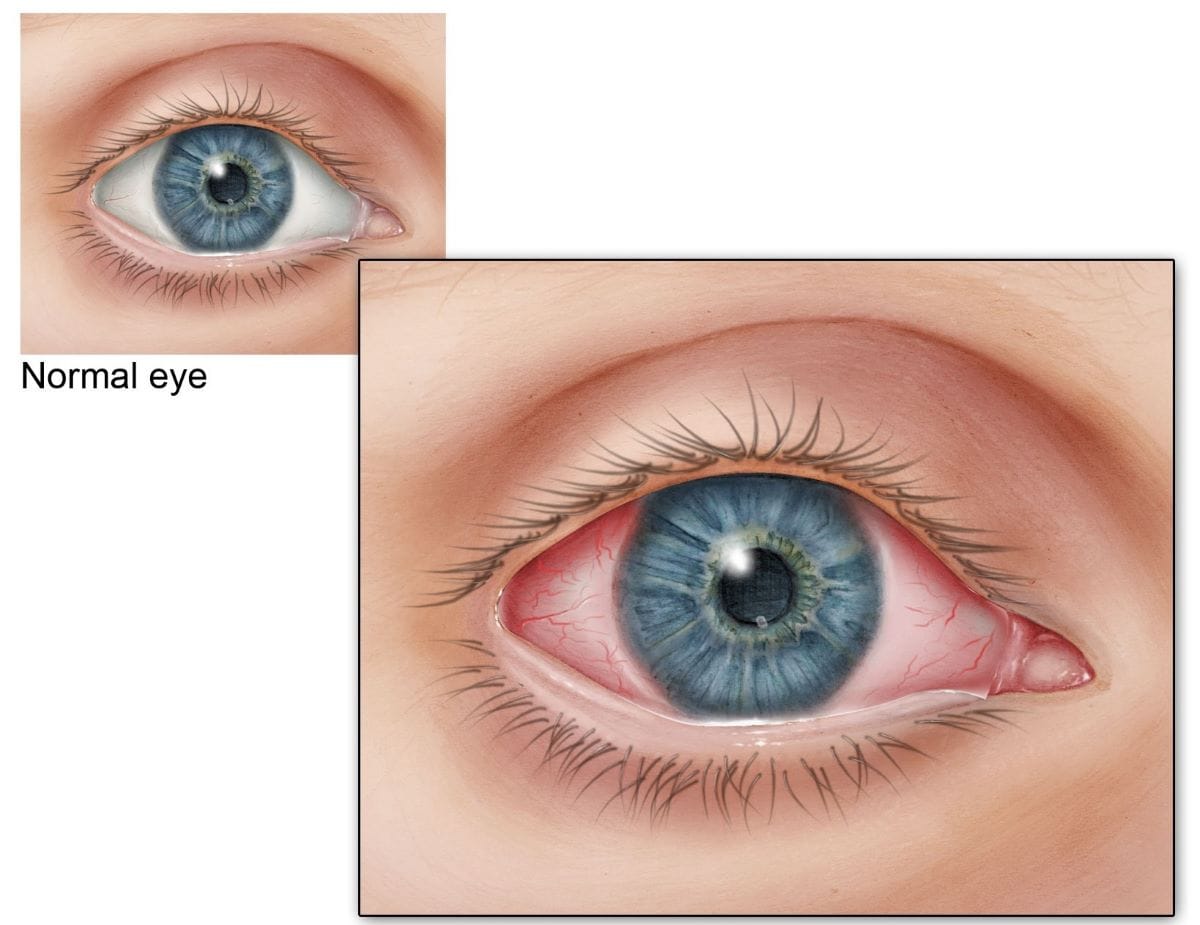 Normal eye compared to an eye with inflamed conjunctiva (or the thin layer over the white of the eye). This is a symptom off pink eye.