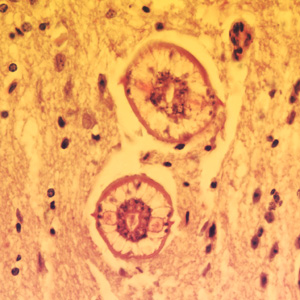 Baylisascaris_brain_400x_BAM1.jpg