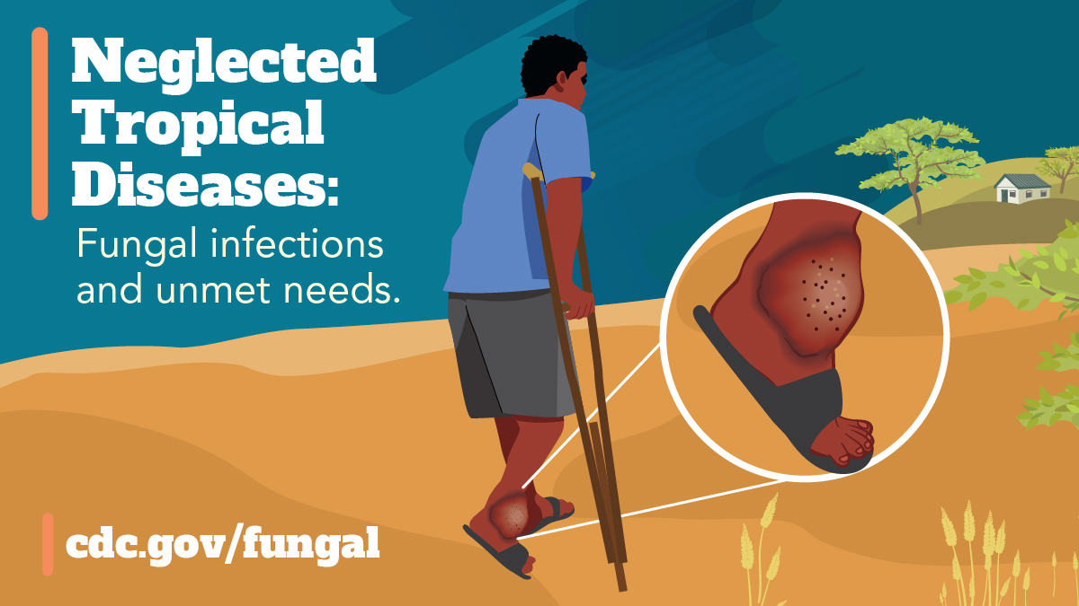 A person using crutches and wearing open toed shoes walking through a rural, arid area. The person’s lower extremity is visibly affected by a fungal infection and is magnified showing skin lesions on their ankle. Text reads. “Neglected tropical diseases: fungal infections and unmet needs.”