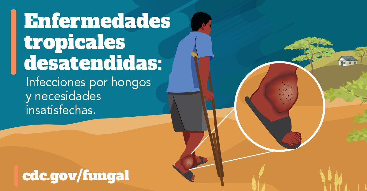 Una persona con una infección por hongos en el pie usando muletas para llegar a un centro de atención médica alejado. El texto dice: "Enfermedades tropicales desatendidas:Infecciones por hongos y necesidades insatisfechas".