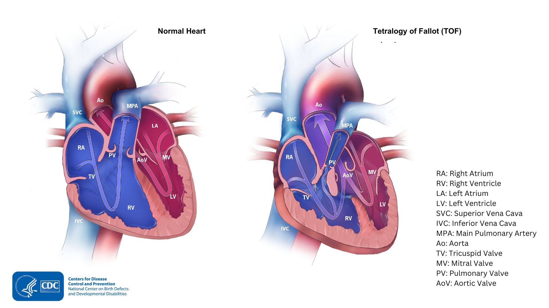 — title missing — A typical heart compared with Tetralogy of Fallot