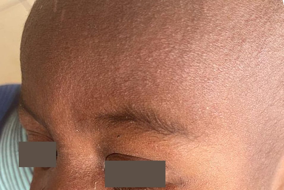 Image of measles rash on the face of a child with darker skin.