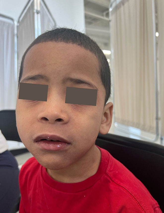 Image of measles rash on forehead.