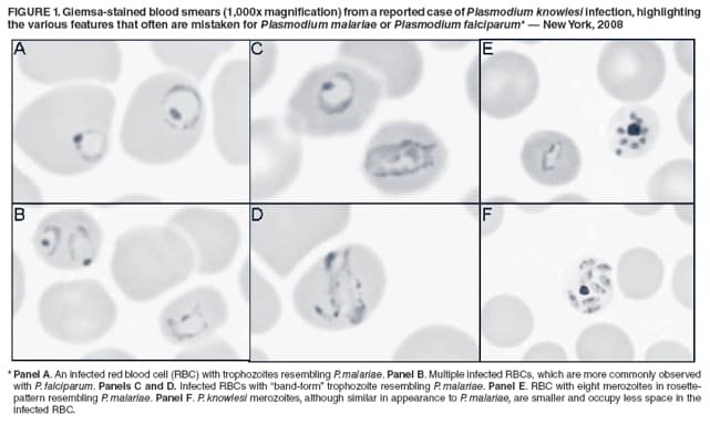 FIGURE 1. Giemsa-stained blood smears (1,000x magnification) from a reported case of Plasmodium knowlesi infection, highlighting the various features that often are mistaken for Plasmodium malariae or Plasmodium falciparum* � New York, 2008