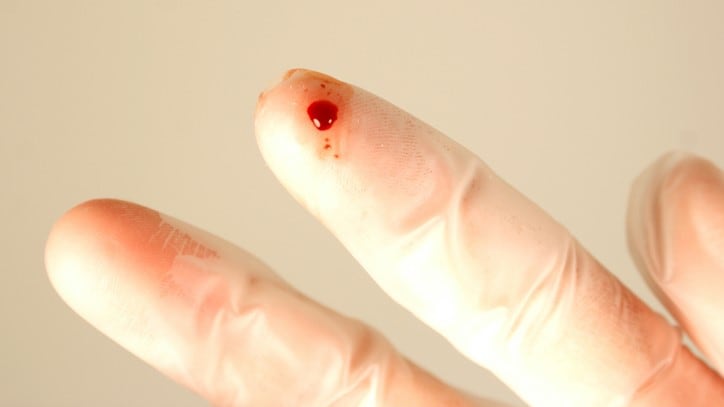 Needlestick injury to gloved finger