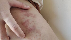 skin reaction showing rash hives allergy and inflammation. The skin has scars and dark spots on the leg of a women.