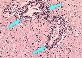 Microscope image of perivascular cuffing and inflammation around a blood vessel