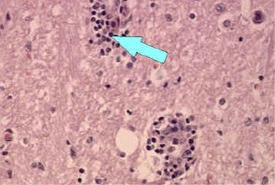 Microscope image of perivascular cuffing and inflammation around a blood vessel