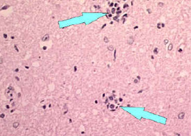 Microscope image of babes nodules