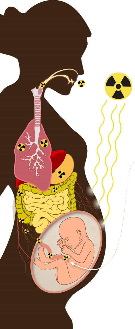 Graphic depicting a pregnant woman and her unborn baby exposed to external radiation