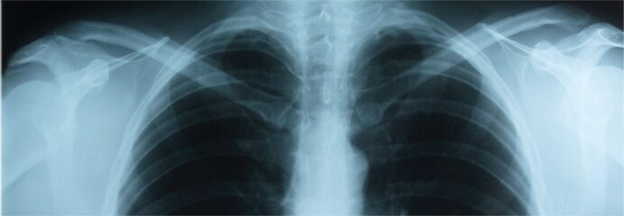 Example of an upper chest x-ray