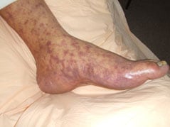 Rocky Mountain spotted fever rash on foot.