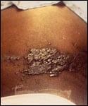 Child with dark skin and a history of leukemia has a maculopapular rash. This was diagnosed as a herpes-zoster outbreak due to the Varicella-zoster virus (VZV) pathogen.