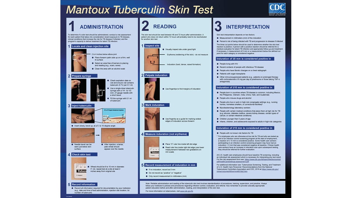 Mantoux Tuberculin Skin Test Wall Chart