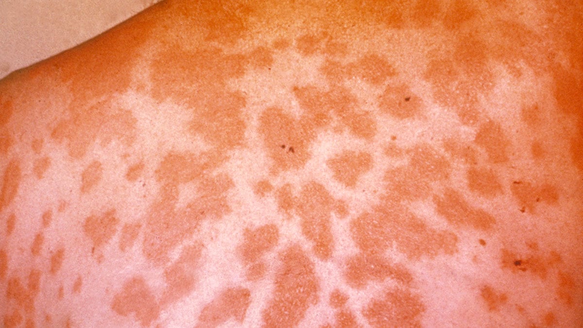 Rash (erythema nodosum) due to Valley fever.