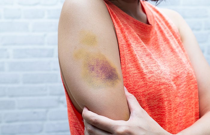 Woman holding her arm that has a large purple and yellow bruise on it