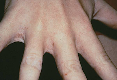 A hand with spread fingers with tiny, pimple-like red spots.