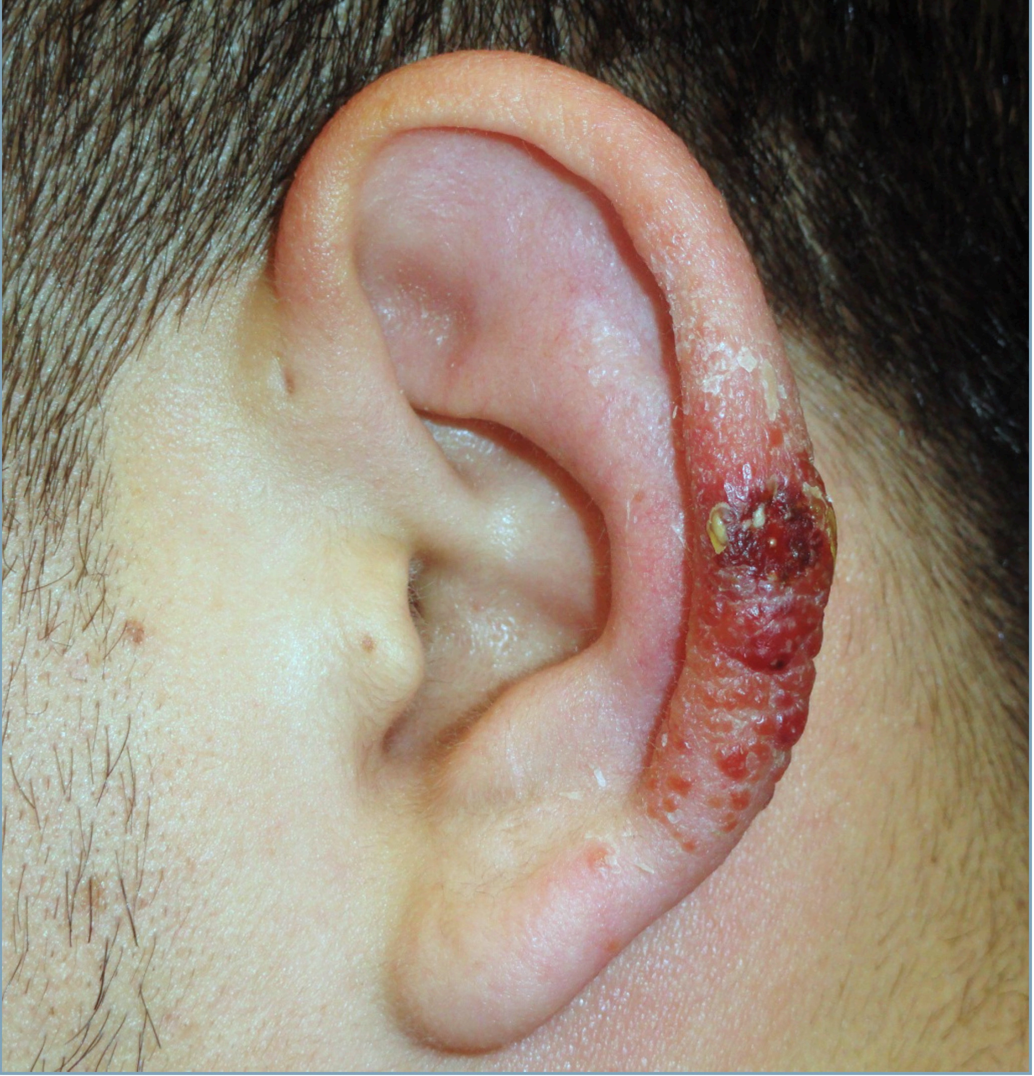 An ear with a raised red and purple ulcer.
